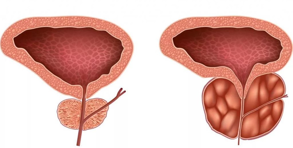 Peran Gaya Hidup Seimbang dalam Menjaga Kenyamanan Prostat